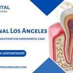 Affordable Root Canal in Los Angeles | ID Dental & Implant Center