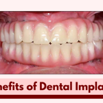 Benefits of Dental Implants with Dr. Anurag Bhargava, Leading Dental Surgeon in Indore