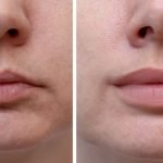 Exploring Lip Enhancement Near Me and Lip Filler Before and After