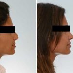 Rhinoplasty in Indore: Expert Nose Job Surgery by Dr. Anurag Bhargava