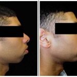 Chin Augmentation & Reduction Surgery: Enhance Your Profile by Dr. Anurag Bhargava