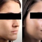 Enhance Your Facial Contours with Expert Cheek Augmentation in Indore