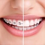 Best Orthodontic Treatment in Hyderabad